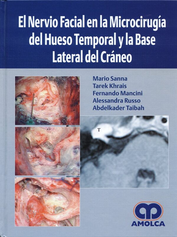 El Nervio Facial en la Microcirugia del Hueso Temporal y la Base Lateral del Craneo